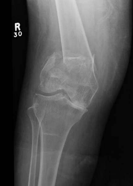 Distal Femur Replacement 1